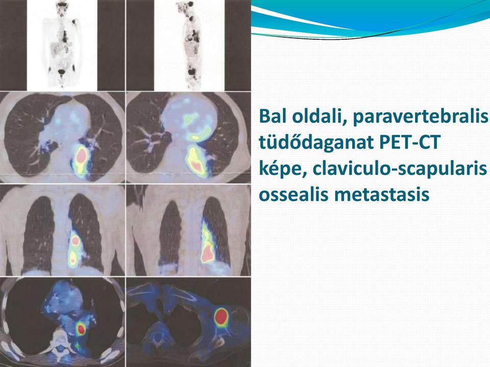 tüdődaganat PET-CT