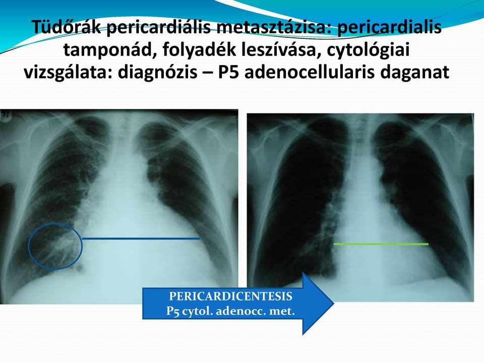 cytológiai vizsgálata: diagnózis P5