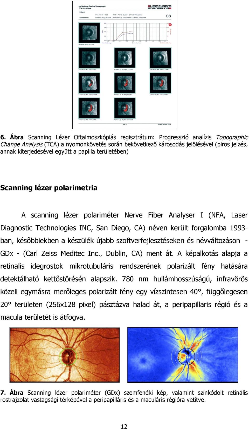 későbbiekben a készülék újabb szoftverfejlesztéseken és névváltozáson GDx - (Carl Zeiss Meditec Inc., Dublin, CA) ment át.
