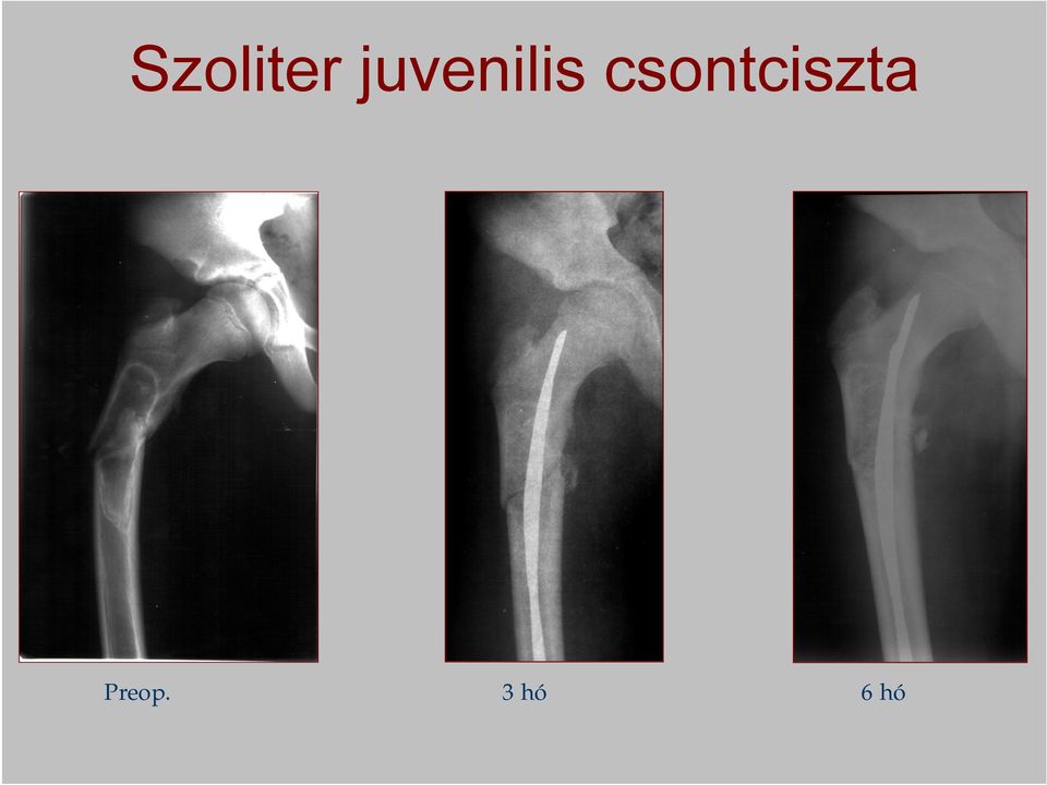 csontciszta