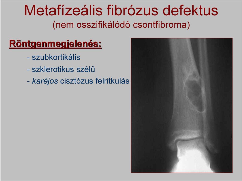 Röntgenmegjelenés: - szubkortikális -
