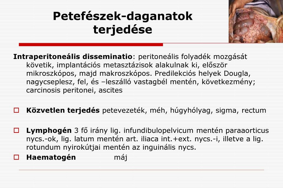 Predilekciós helyek Dougla, nagycseplesz, fel, és leszálló vastagbél mentén, következmény; carcinosis peritonei, ascites Közvetlen terjedés