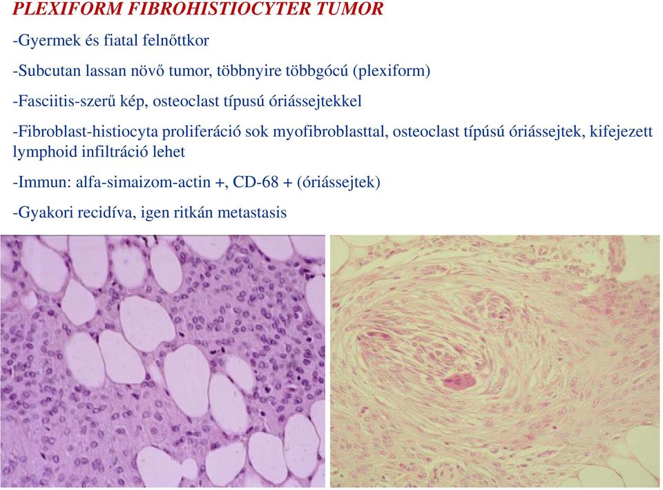 -Fibroblast-histiocyta proliferáció sok myofibroblasttal, osteoclast típúsú óriássejtek, kifejezett