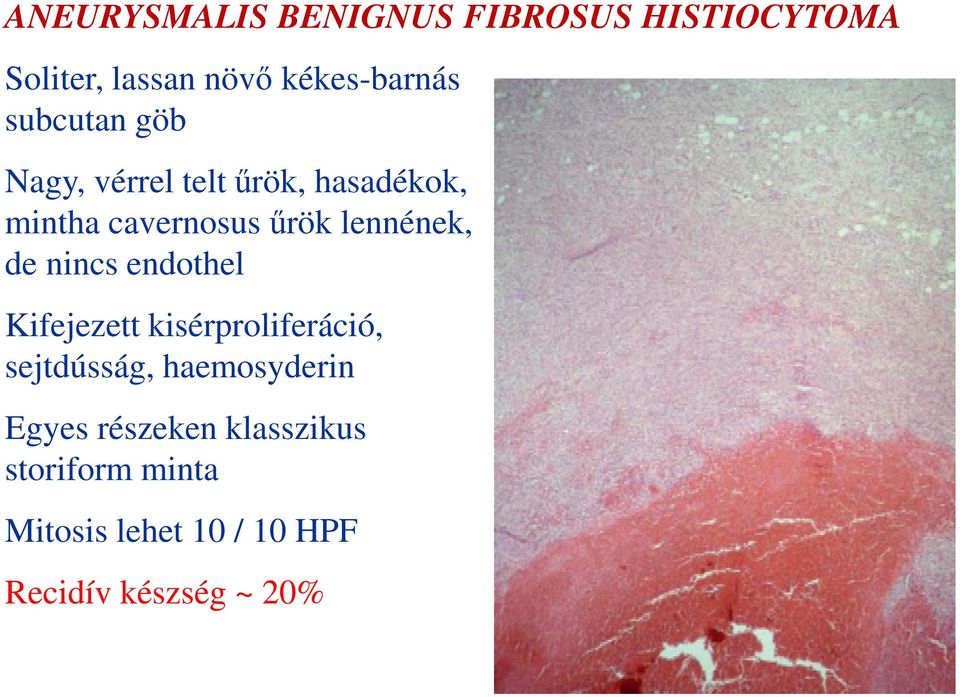 de nincs endothel Kifejezett kisérproliferáció, sejtdússág, haemosyderin Egyes