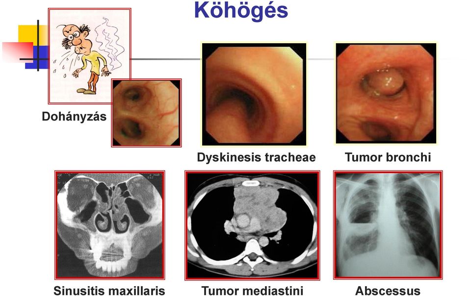 Tumor bronchi Sinusitis