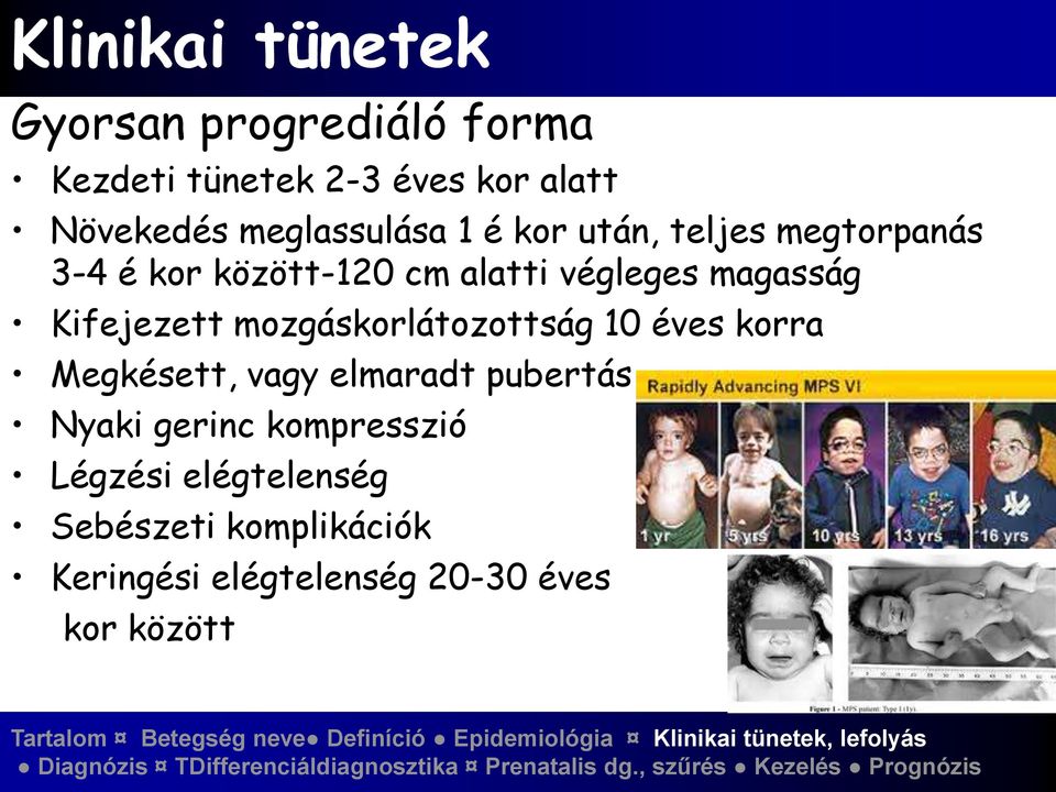 magasság Kifejezett mozgáskorlátozottság 10 éves korra Megkésett, vagy elmaradt pubertás