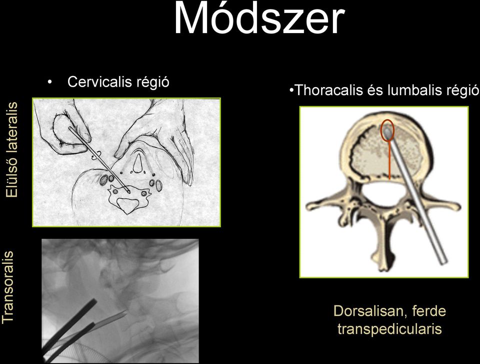 Transoralis Elülső lateralis