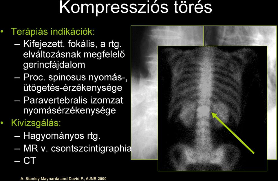 spinosus nyomás-, ütögetés-érzékenysége Paravertebralis izomzat