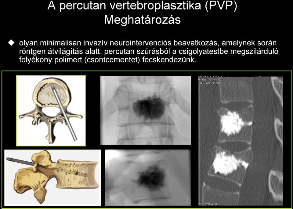 során röntgen átvilágítás alatt, percutan szúrásból a