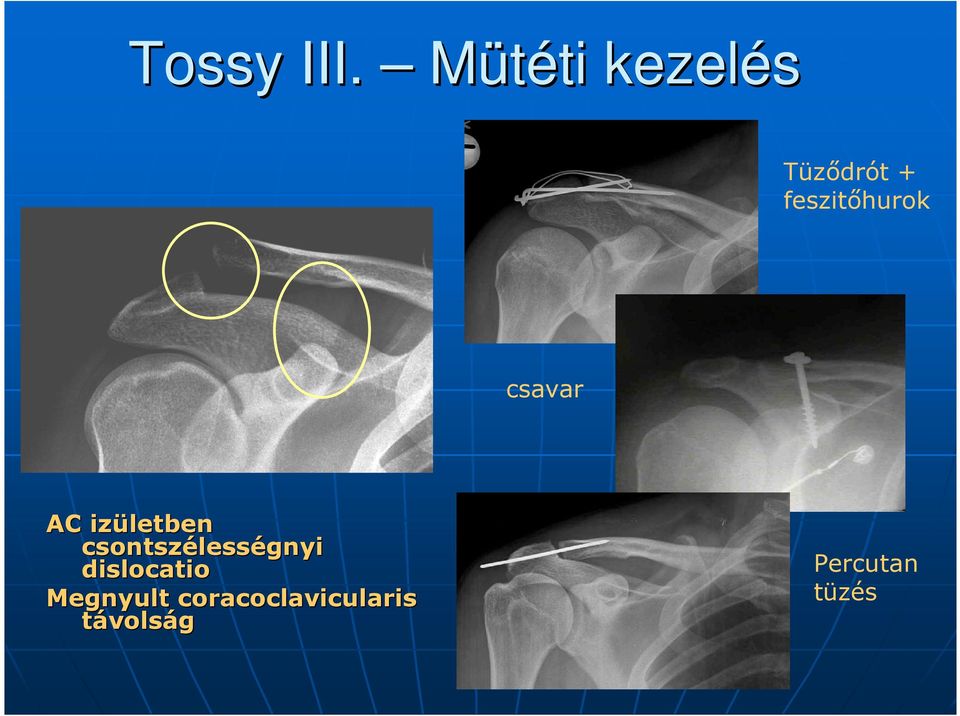 feszitőhurok csavar AC izületben