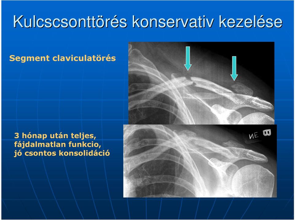 A felső végtag sérülései. SE Traumatológia Tanszék - PDF Free Download