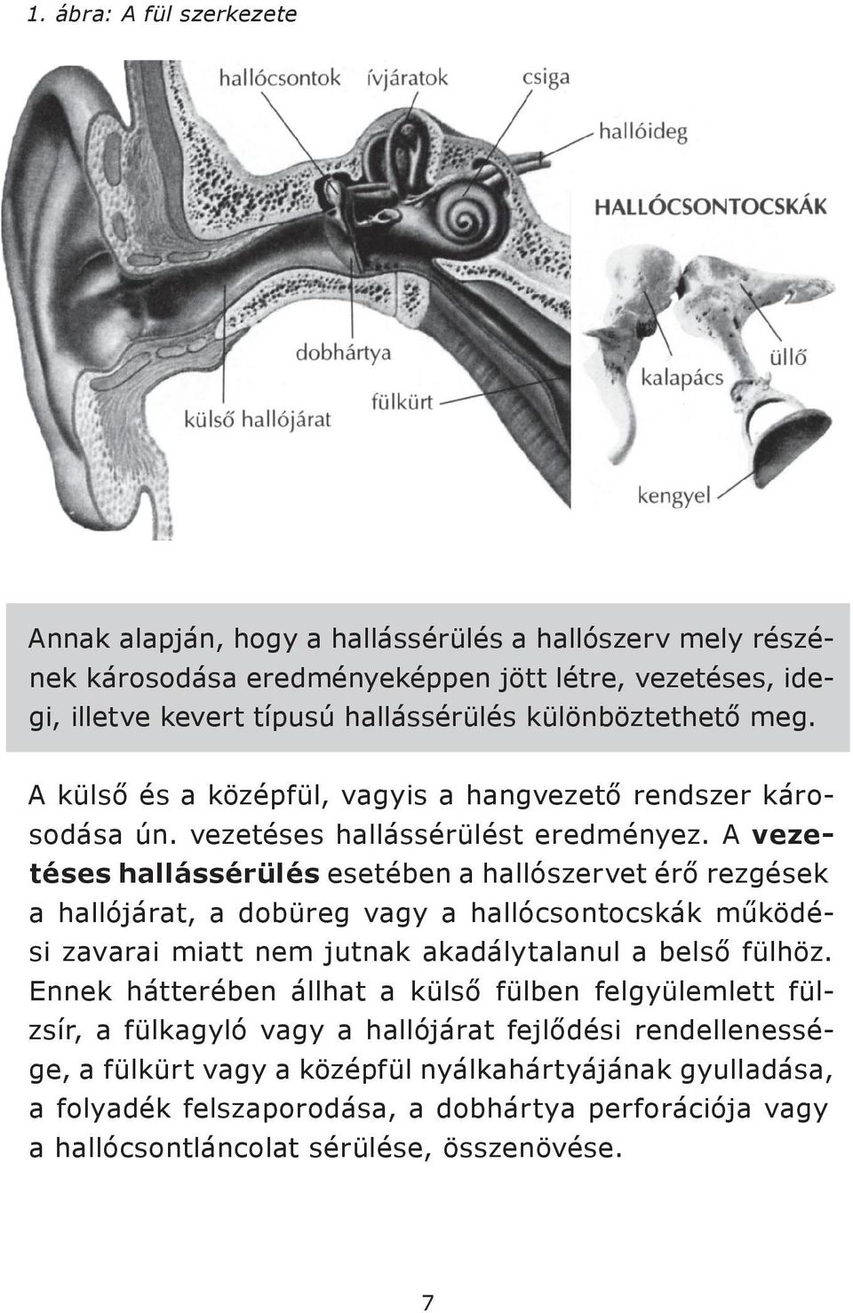 A vezetéses hallássérülés esetében a hallószervet érő rezgések a hallójárat, a dobüreg vagy a hallócsontocskák működési zavarai miatt nem jutnak akadálytalanul a belső fülhöz.