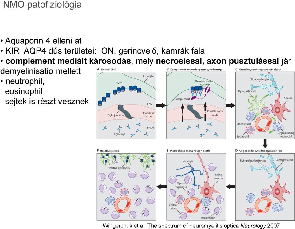 axon pusztulással jár demyelinisatio mellett neutrophil, eosinophil sejtek
