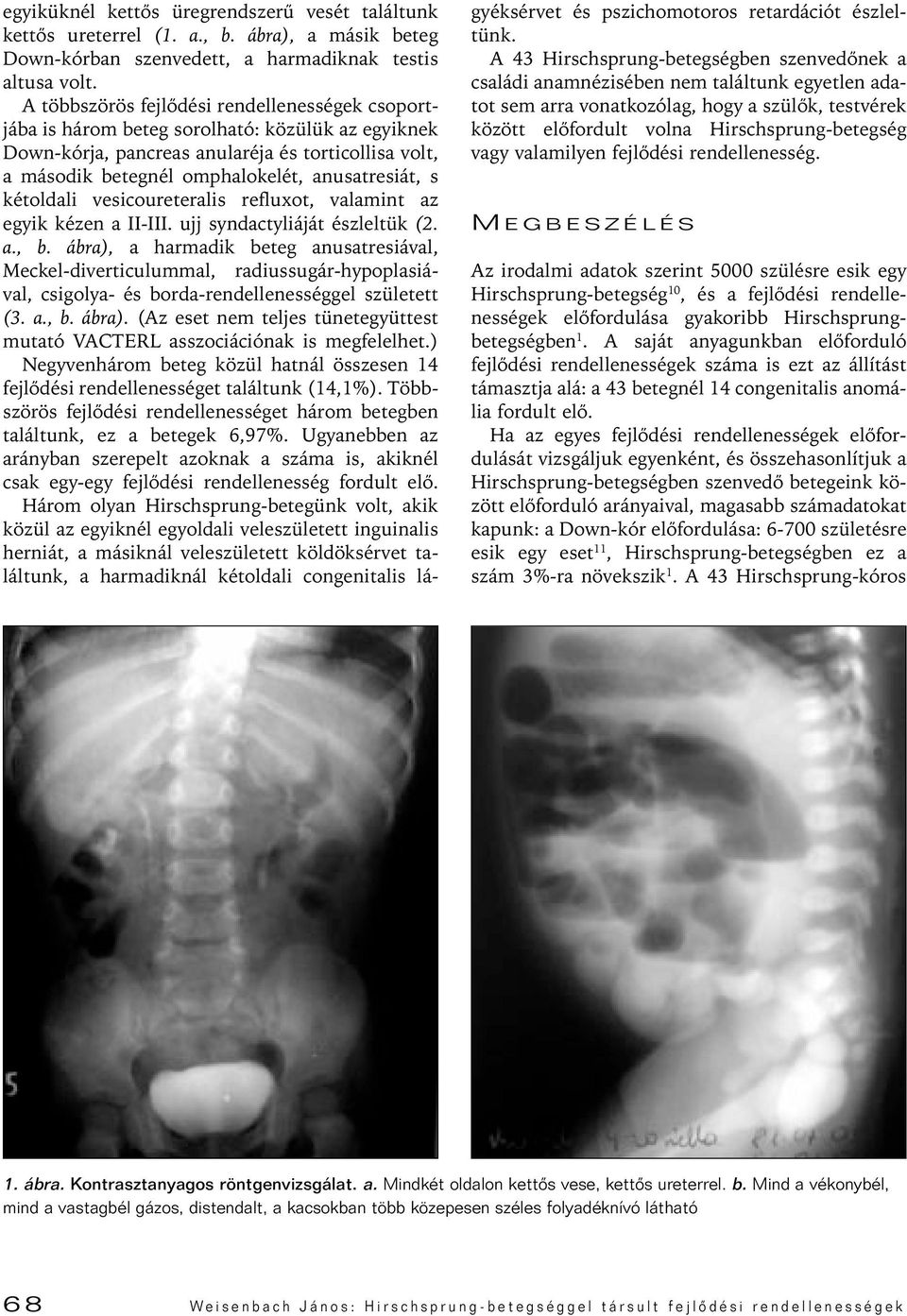 vesicoureteralis refluxot, valamint az egyik kézen a II-III. ujj syndactyliáját észleltük (2. a., b.