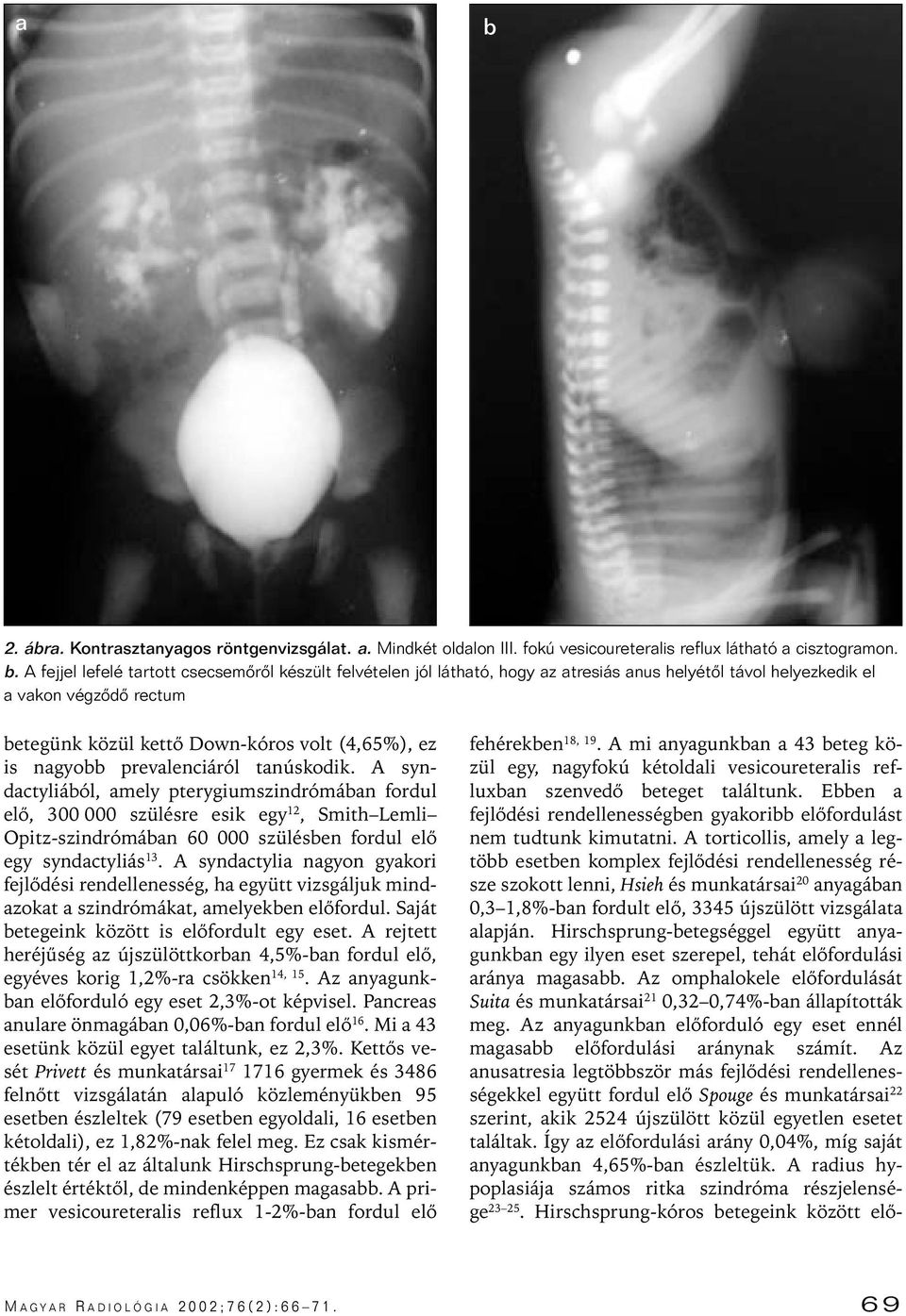 A syndactyliából, amely pterygiumszindrómában fordul elô, 300 000 szülésre esik egy 12, Smith Lemli Opitz-szindrómában 60 000 szülésben fordul elô egy syndactyliás 13.