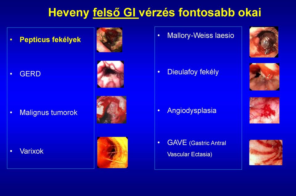 Dieulafoy fekély Malignus tumorok