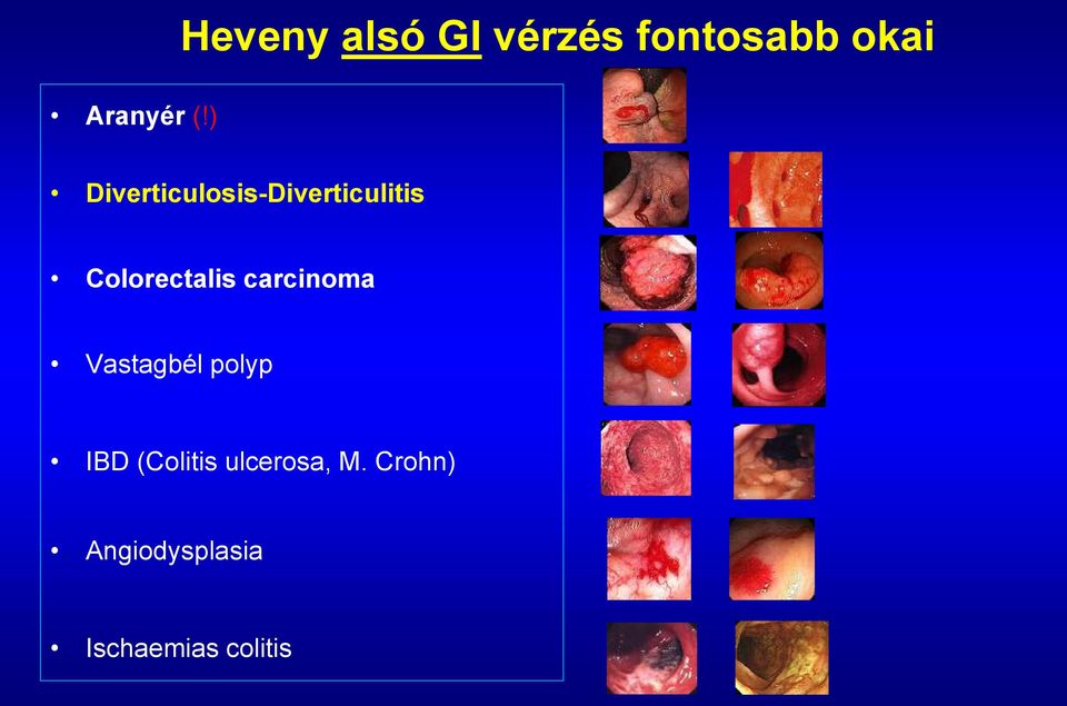 Colorectalis carcinoma Vastagbél polyp IBD