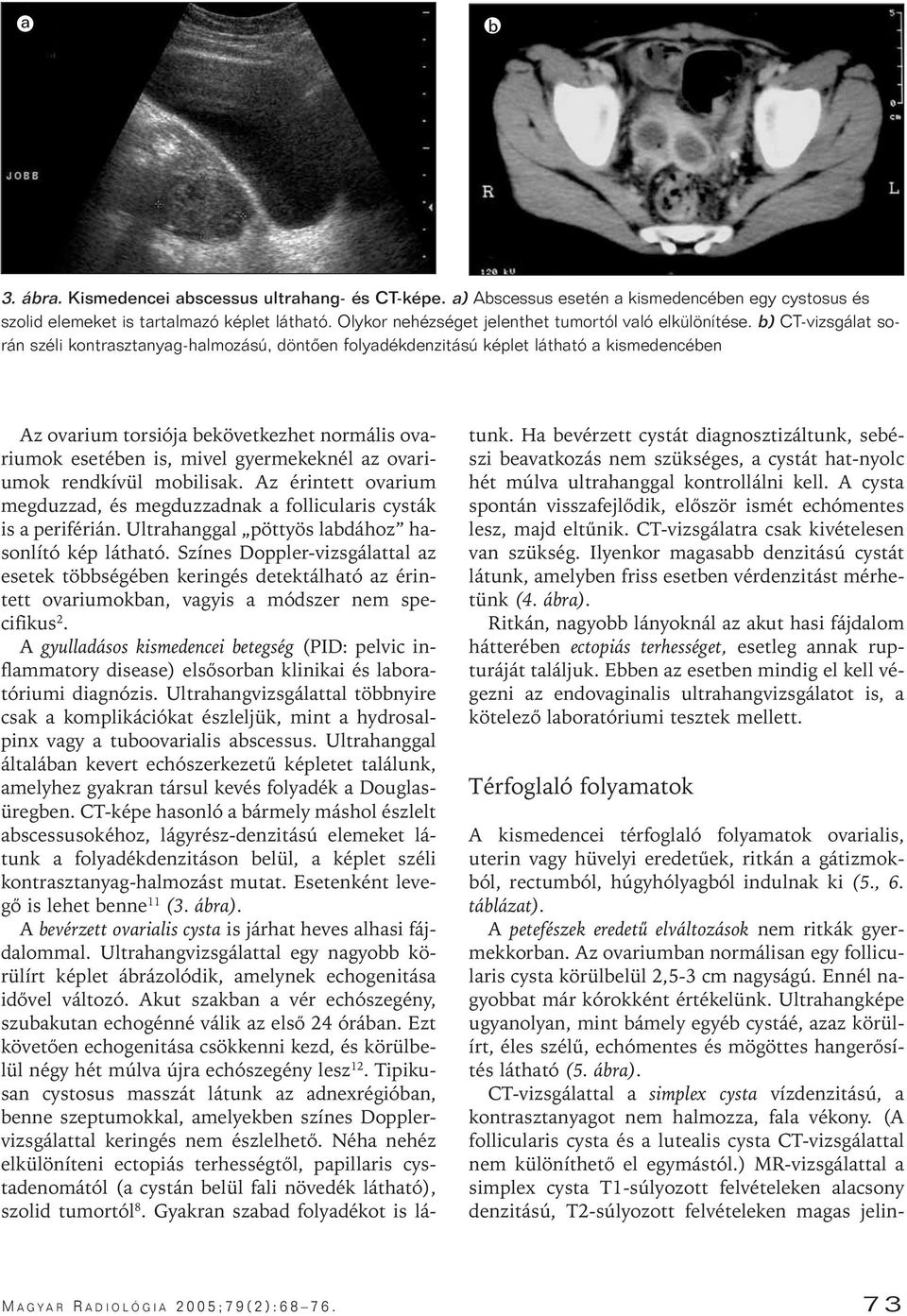 b) CT-vizsgálat során széli kontrasztanyag-halmozású, döntôen folyadékdenzitású képlet látható a kismedencében Az ovarium torsiója bekövetkezhet normális ovariumok esetében is, mivel gyermekeknél az