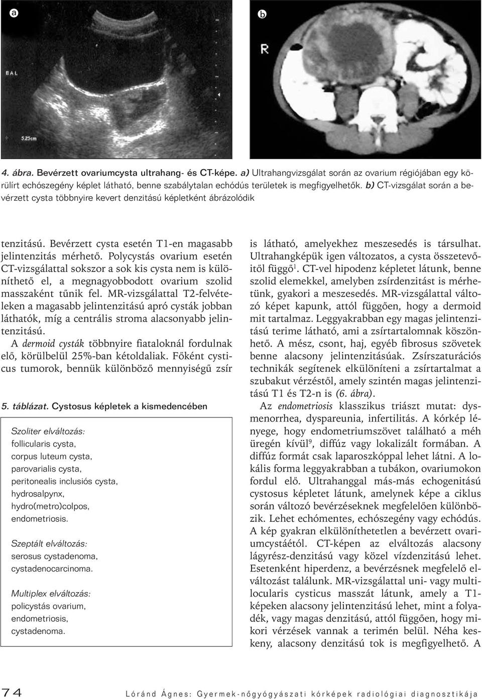 b) CT-vizsgálat során a bevérzett cysta többnyire kevert denzitású képletként ábrázolódik tenzitású. Bevérzett cysta esetén T1-en magasabb jelintenzitás mérhetô.