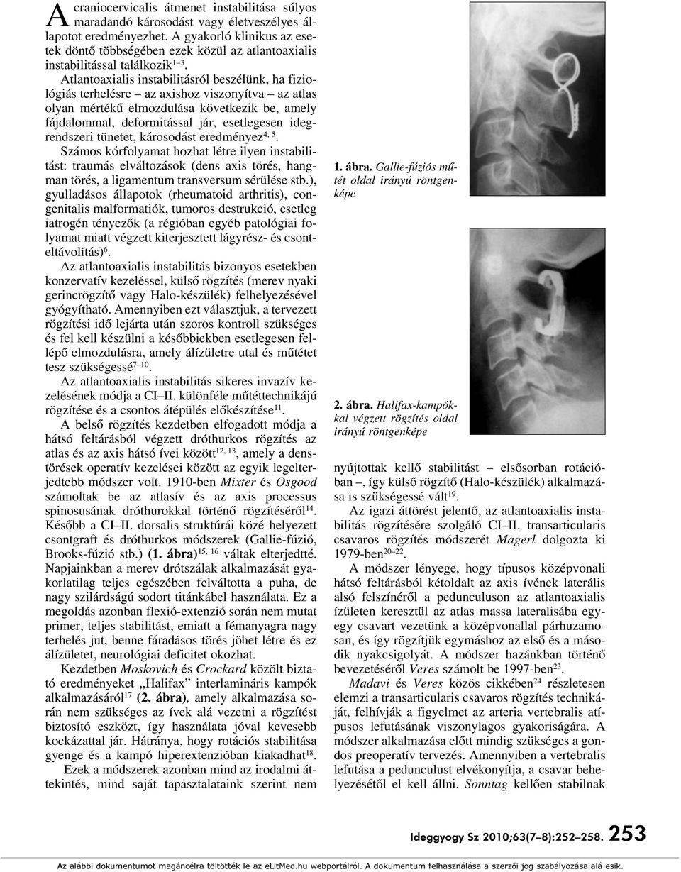 Atlantoaxialis instabilitásról beszélünk, ha fiziológiás terhelésre az axishoz viszonyítva az atlas olyan mértékû elmozdulása következik be, amely fájdalommal, deformitással jár, esetlegesen