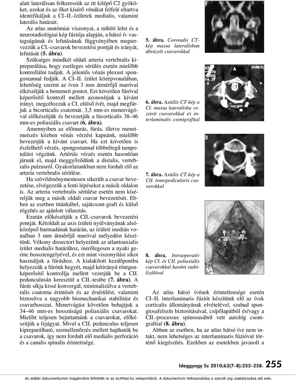 -csavarok bevezetési pontját és irányát, lefutását (5. ábra). Szükséges mindkét oldali arteria vertebralis kipreparálása, hogy esetleges sérülés esetén mielôbb kontrollálni tudjuk.