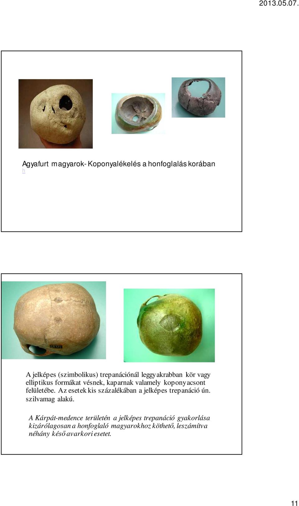 Az esetek kis százalékában a jelképes trepanáció ún. szilvamag alakú.