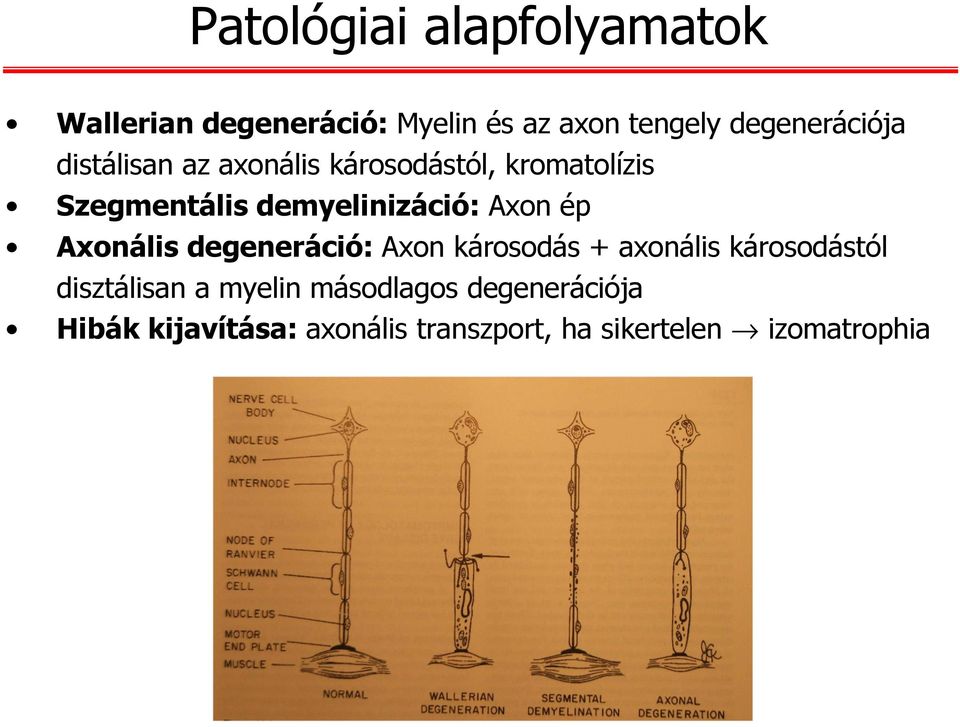 demyelinizáció: Axon ép Axonálisdegeneráció: Axon károsodás + axonális károsodástól