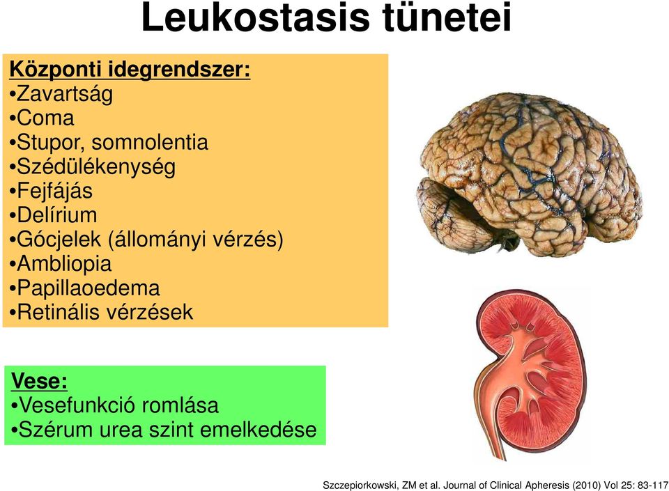 Papillaoedema Retinális vérzések Vese: Vesefunkció romlása Szérum urea szint