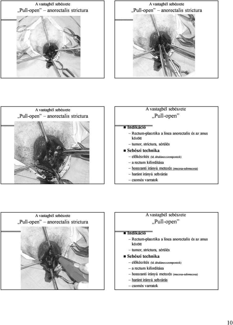 általános szempontok) a rectum kifordítása hosszanti irányú metszés (mucosa (mucosa--submucosa) haránt irányú sebzárás csomós varratok Pull--open anorectalis strictura