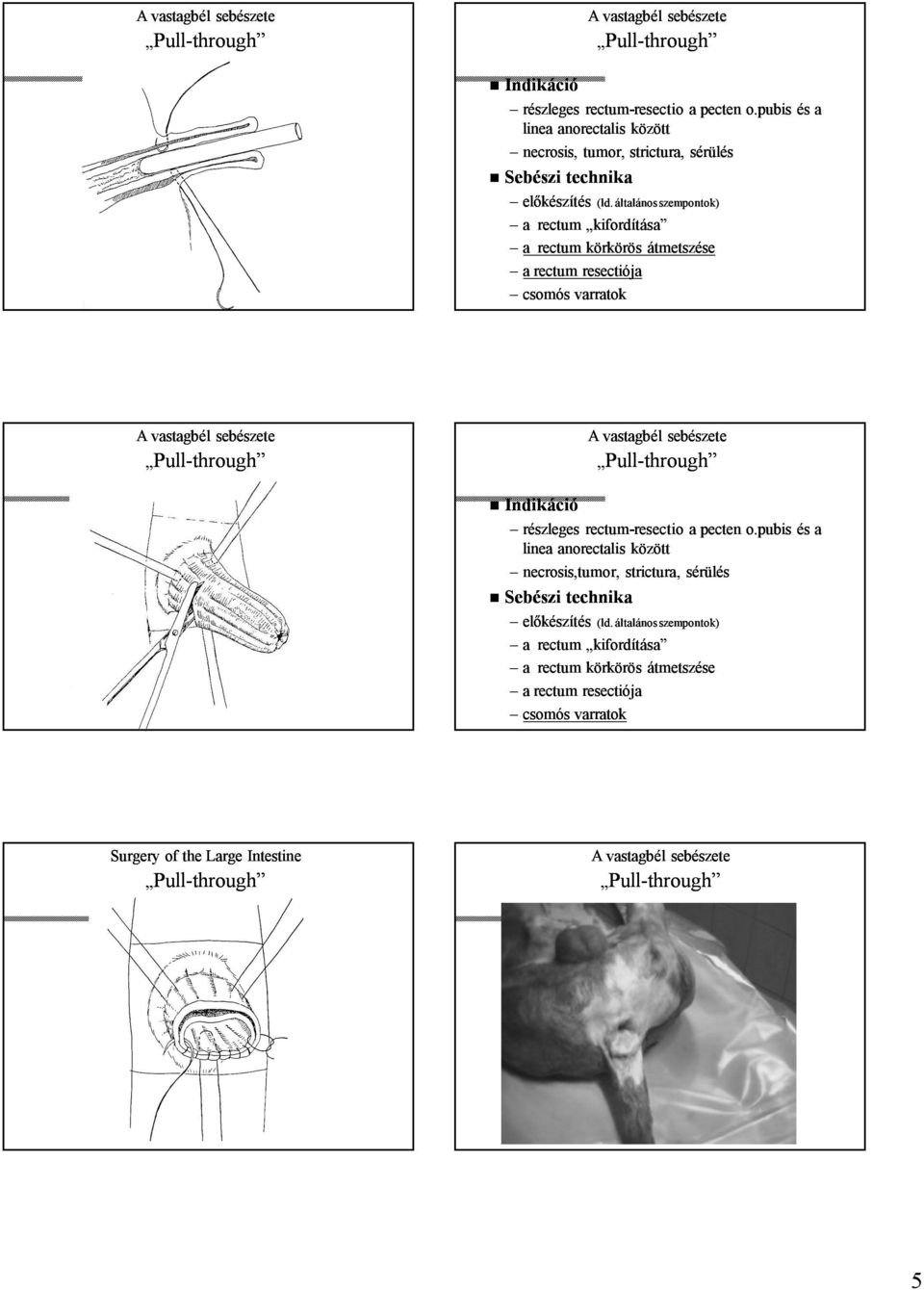 általános szempontok) a rectum kifordítása a rectum körkörös átmetszése a rectum resectiója csomós varratok pubis és a linea anorectalis között