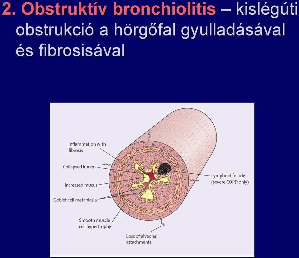 kislégúti obstrukció a