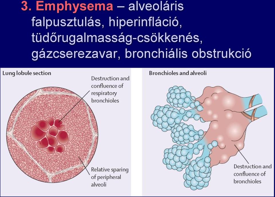 tüdőrugalmasság-csökkenés,