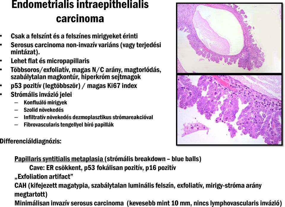 Konfluáló mirigyek Szolid növekedés Infiltratív növekedés dezmoplasztikus strómareakcióval Fibrovascularis tengellyel bíró papillák Differenciáldiagnózis: Papillaris syntitialis metaplasia (strómális