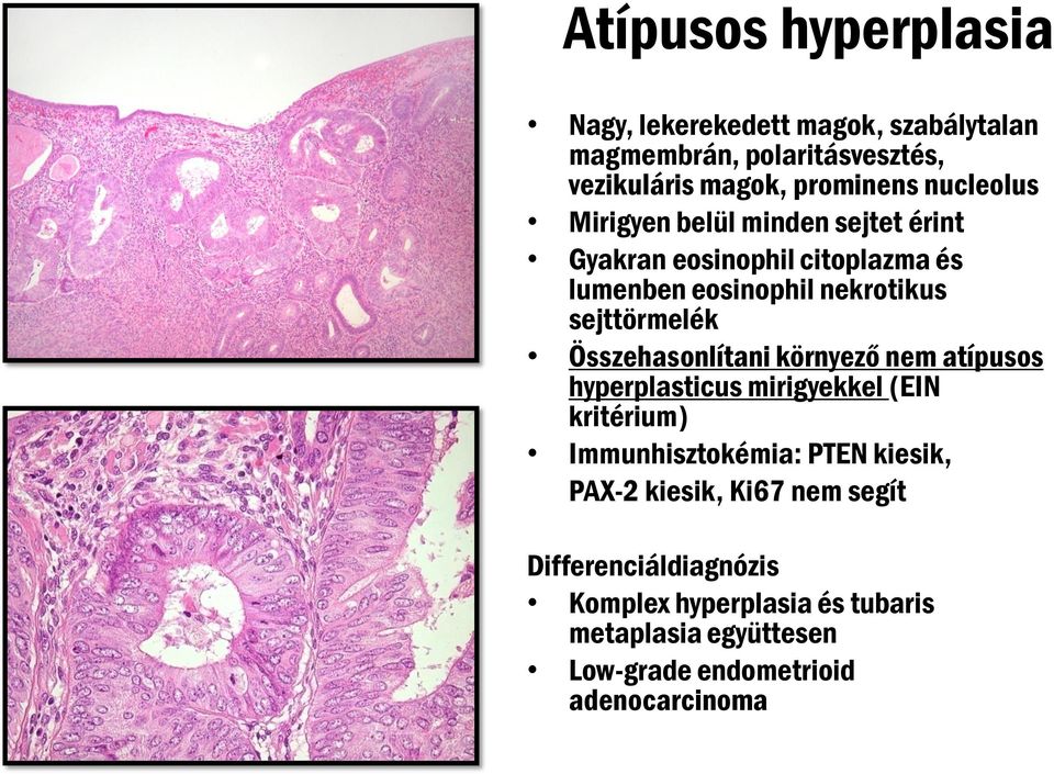 Összehasonlítani környező nem atípusos hyperplasticus mirigyekkel (EIN kritérium) Immunhisztokémia: PTEN kiesik, PAX-2
