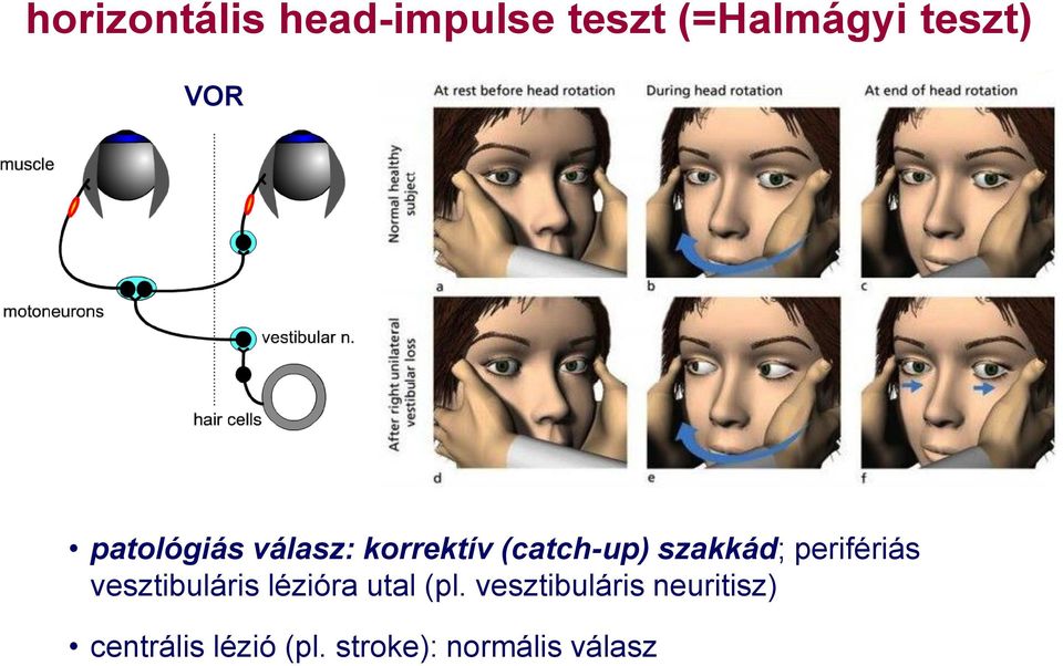 perifériás vesztibuláris lézióra utal (pl.