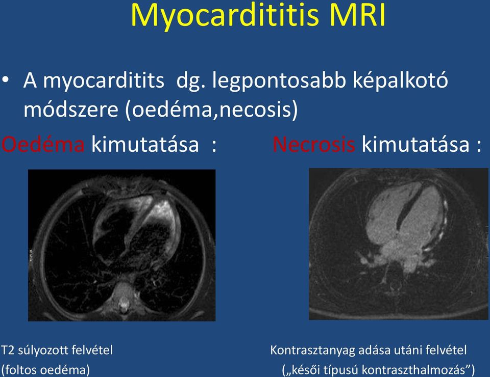 kimutatása : Necrosis kimutatása : T2 súlyozott felvétel