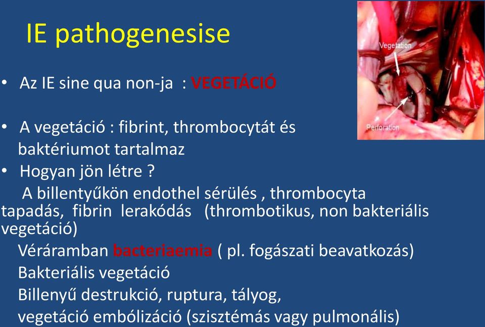 A billentyűkön endothel sérülés, thrombocyta tapadás, fibrin lerakódás (thrombotikus, non bakteriális