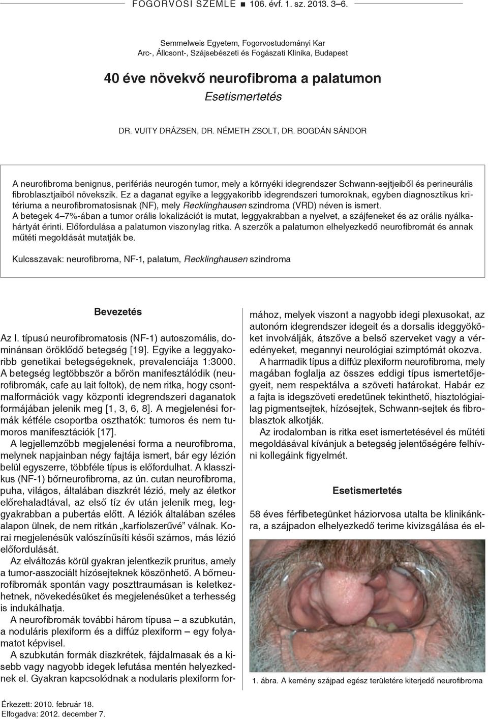 Bogdán Sándor A neurofibroma benignus, perifériás neurogén tumor, mely a környéki idegrendszer Schwann-sejtjeiből és perineurá lis fibroblasztjaiból növekszik.