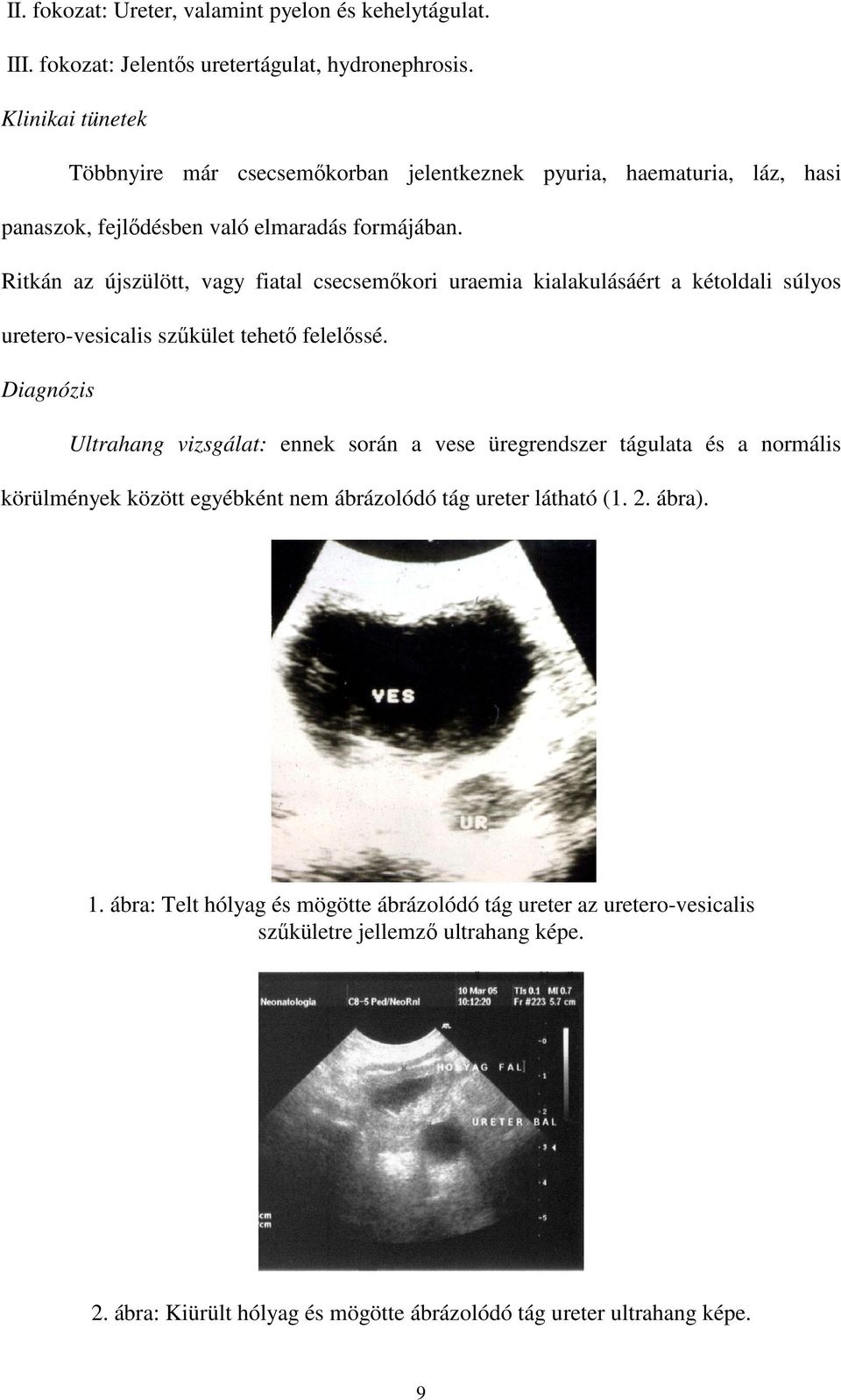 Ritkán az újszülött, vagy fiatal csecsemıkori uraemia kialakulásáért a kétoldali súlyos uretero-vesicalis szőkület tehetı felelıssé.