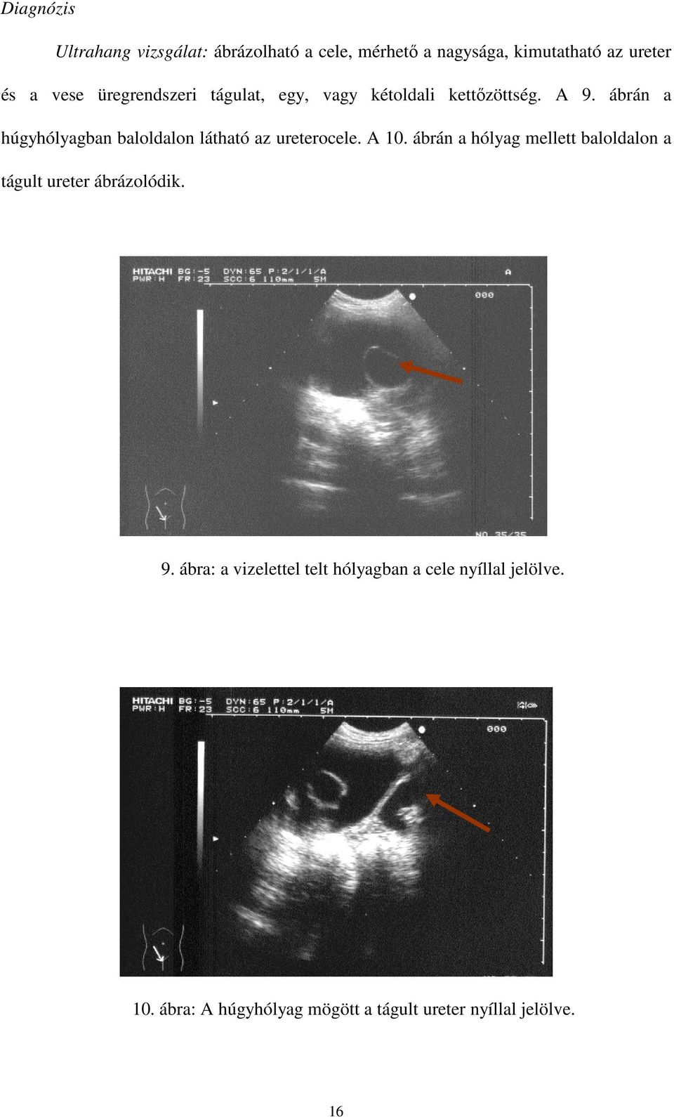 ábrán a húgyhólyagban baloldalon látható az ureterocele. A 10.