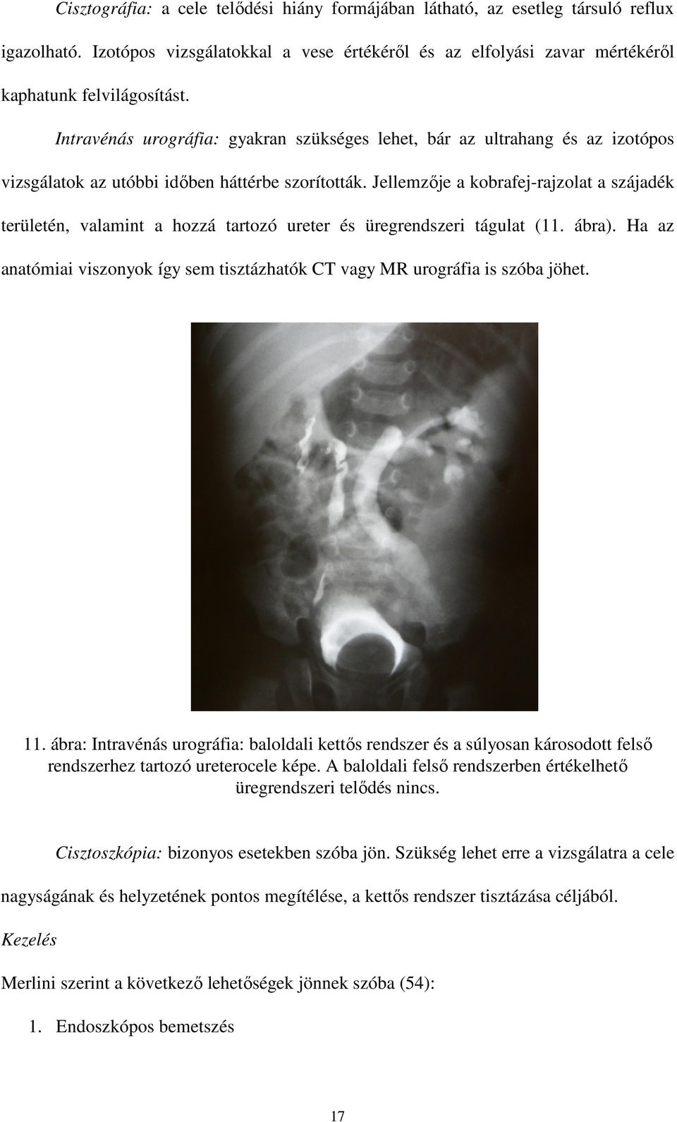 Jellemzıje a kobrafej-rajzolat a szájadék területén, valamint a hozzá tartozó ureter és üregrendszeri tágulat (11. ábra).