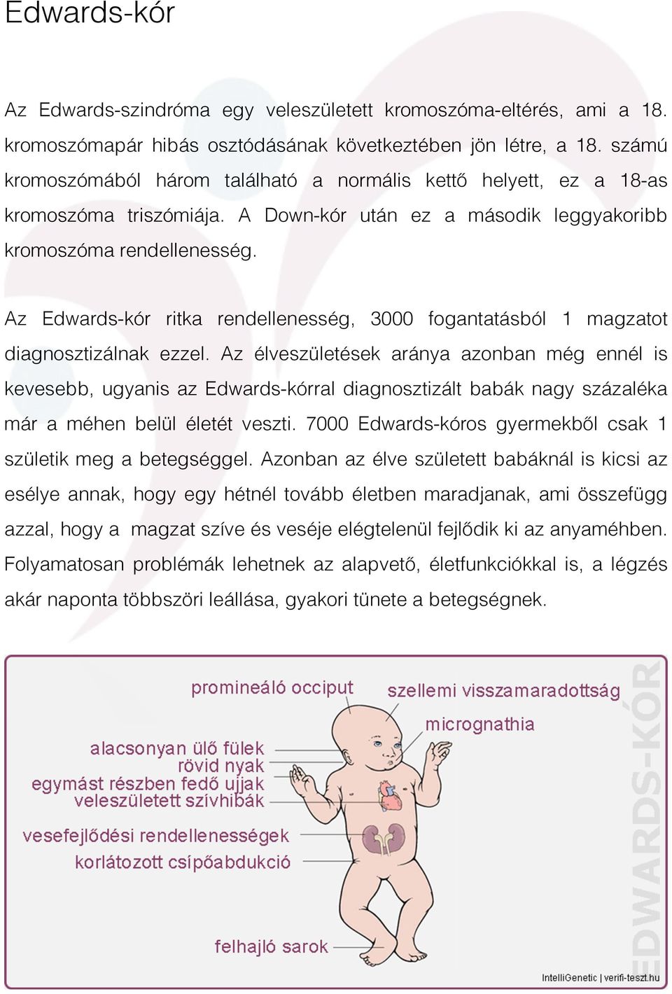 Az Edwards-kór ritka rendellenesség, 3000 fogantatásból 1 magzatot diagnosztizálnak ezzel.