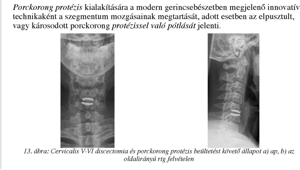 károsodott porckorong protézissel való pótlását jelenti. 13.