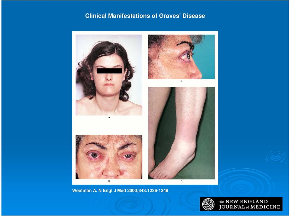 Graves' Disease