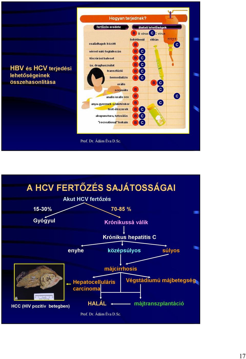Krónikus hepatitis enyhe középsúlyos súlyos májcirrhosis Hepatocelluláris