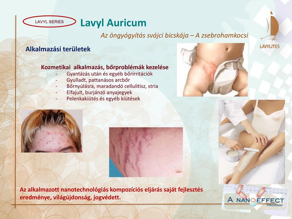 pattanásos arcbőr - Bőrnyúlásra, maradandó cellulitisz, stria - Elfajult, burjánzó anyajegyek -