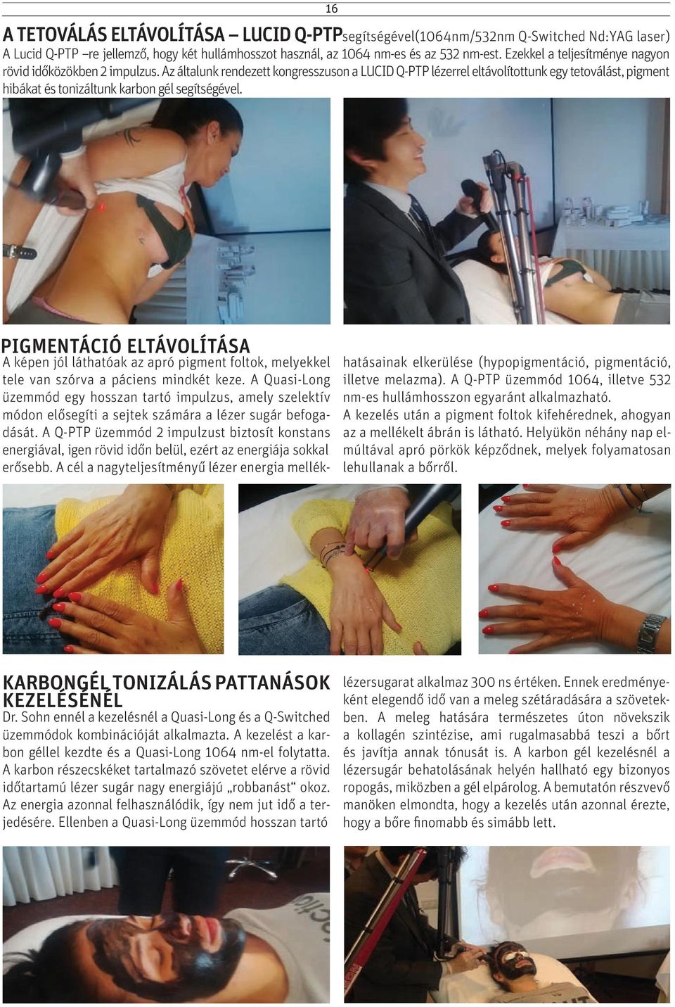 Az általunk rendezett kongresszuson a LUCID Q-PTP lézerrel eltávolítottunk egy tetoválást, pigment hibákat és tonizáltunk karbon gél segítségével.