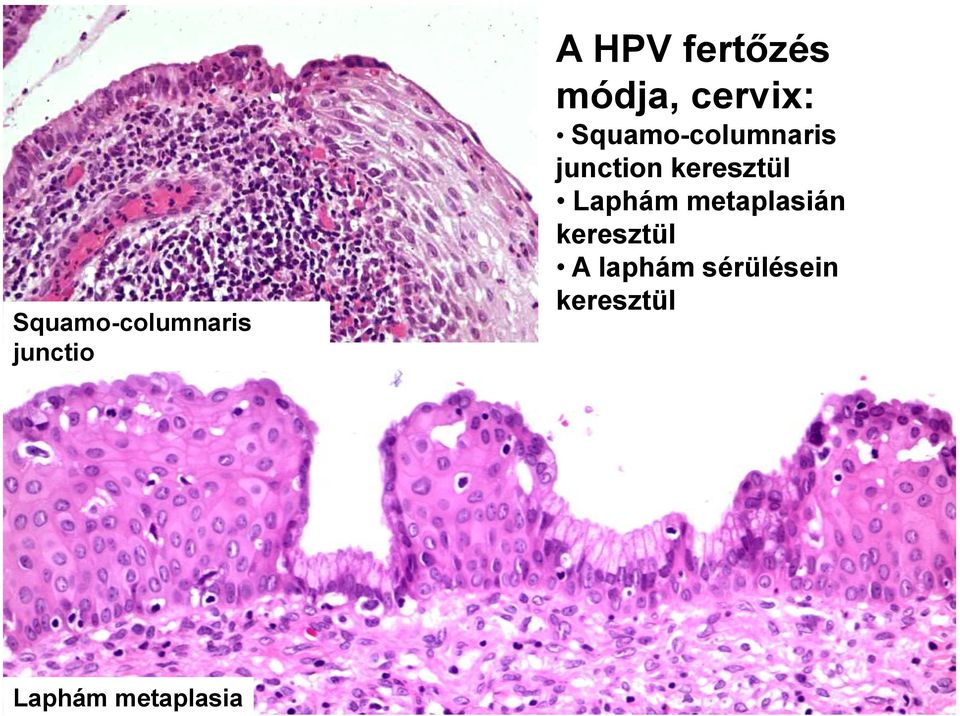 keresztül Laphám metaplasián keresztül A