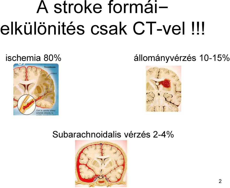 !! ischemia Agyi infarktus 80% 80%