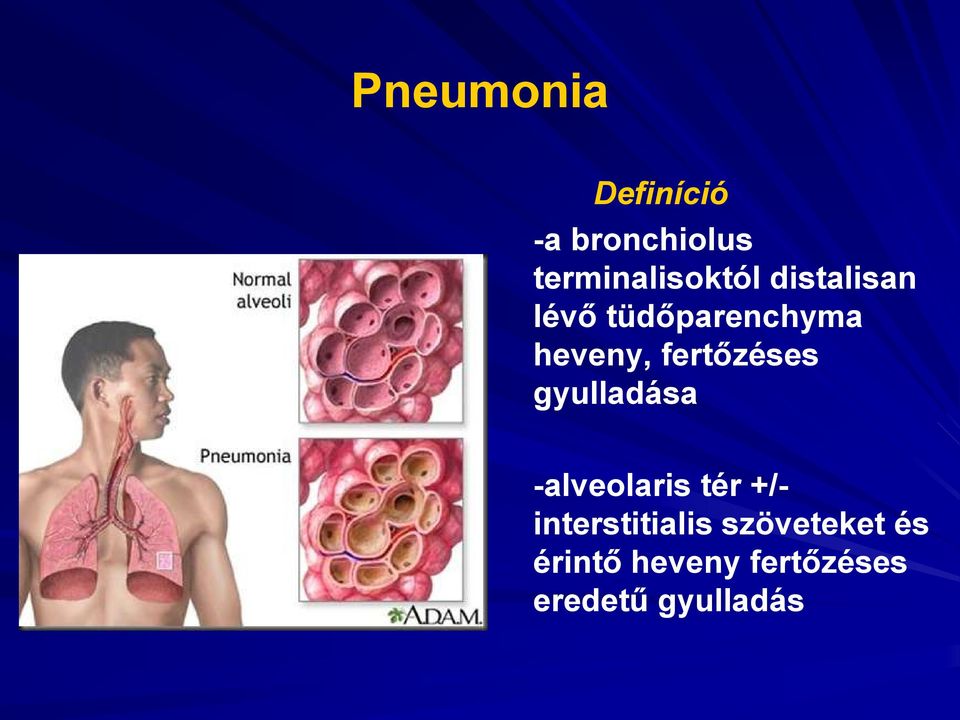 gyulladása -alveolaris tér +/- interstitialis